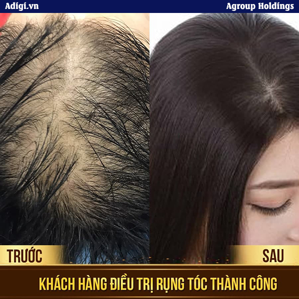 Công nghệ chữa rụng tóc ở nữ giới giúp phục hồi tận sâu chân tóc