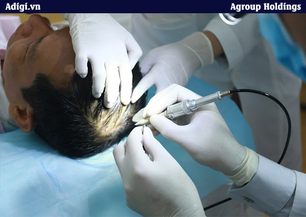Công nghệ cấy ghép tóc của Agroup là một trong những công nghệ hiện đại và an toàn nhất