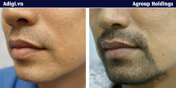 Công nghệ cấy râu an toàn, đem lại hiệu quả trong thời gian ngắn
