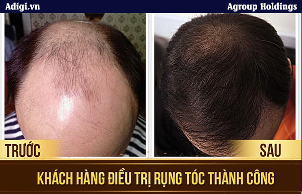 Tình trạng hói, hở da đầu được khắc phục triệt để sau khi cấy tóc