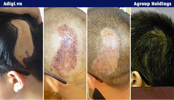 Khách hàng điều trị tóc thành công nhờ công nghệ cấy tóc của Agroup