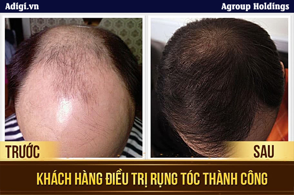 Tình trạng hói đầu, hở da đầu được loại bỏ với công nghệ tại Adigi