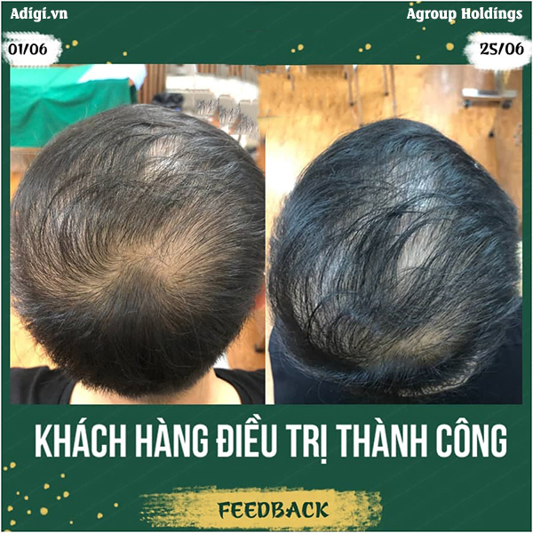 Công nghệ điều trị tóc từ thiên nhiên của Agroup giúp khách hàng cải thiện tình trạng rụng tóc, hói đầu